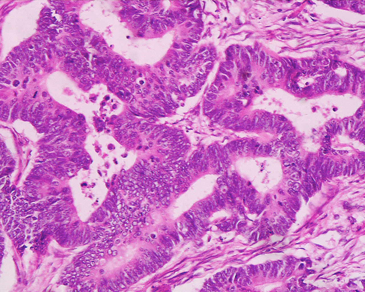 adenocarcinoma-moderadamente-diferenciado-invasivo