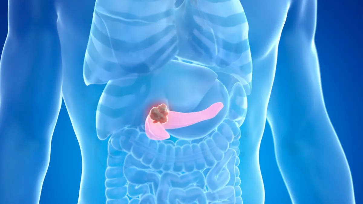 3 Problemas del cáncer de páncreas y cómo solucionarlos
